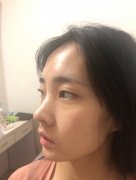 呼和浩特做自体脂肪丰太阳穴价格贵吗