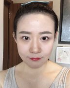 呼市做双眼皮修复手术效果怎么样呢