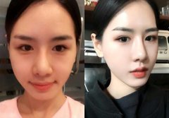 隆鼻手术术后注意事项有哪些呢