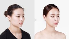 割双眼皮手术注意事项有哪些呢